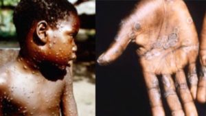 monkeypox
